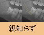 親知らず